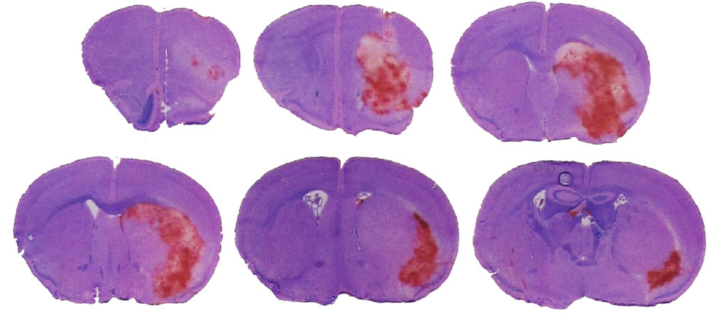 Intracerebral Hemorrhage - Neurovascular Research Unit